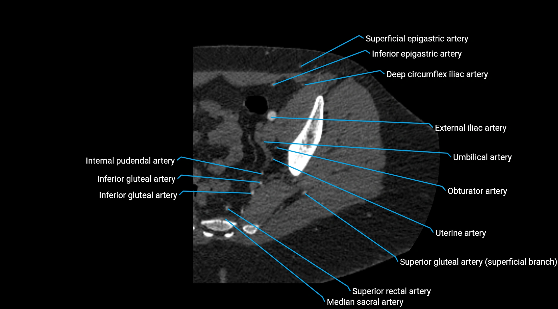 CTA lower limb cross sectional anatomy labelled image _38.webp